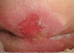 The skin forms a blister or sore. Partial thickness skin loss or ulceration involving the epidermis, dermis, or both