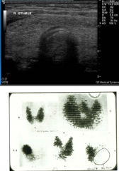 Diffusely overactive gland in bottom image.