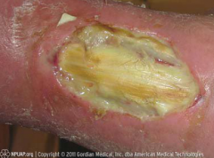 Full-thickness skin loss, with destruction, tissue necrosis, or damage to underlying muscle, bone, and sometimes tendons and joints