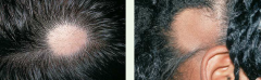 clearly demarcated round or oval patches of hair loss, usually affecting young adults and children. no visible scaling or inflammation