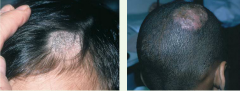 Round scaling patches of alopecia. Hairs are broken off close to the surface of the scalp. Usually caused by fungal infection from Trichyophyton tonsurans fromm humans, less commonly from microsporum canis from dogs or cats.