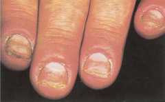 superficial infection of the proximal and lateral nail folds adjacent to the nail plate. The nail folds are often red, swollen, and tender. Represents the most common infection of the hand, usually from S. aureus or Strep species. Arises from loca...
