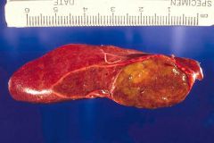 1. Cavernous hemangioma (most common)

2. Focal nodular hyperplasia

3. Liver cell adenoma (associated with oral contraceptives) - Pictured 
