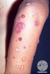 Case 3:
- 6 yo girl w/ a week of blisters on her arms

How would you describe these lesions?
