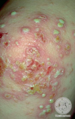 Crusted lesions (where it has ruptured) and pustules (cloudy pustules)
- Honey colored crust is characteristic of impetigo
- Caused by bacterial infection