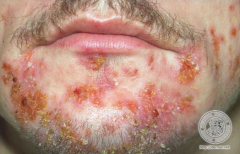 What is the description of this rash? What is it?