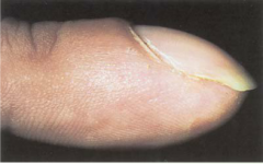 bulbous swelling of the soft tissue at the nail base. Seen in congenital heart disease, interstitial lung disease and lung cancer, inflammatory bowel diseasesm and malignancies