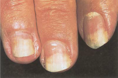 painless separation of the whitened opaque nail plate from the pinker translucent nail bed. Local causes include excess manicuring, psoriasis, fungal infection, and allergic reactions to nail cosmetics. Systemic causes include diabetes, anemia, ph...