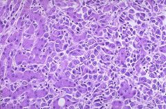 1. Large univocal lesion; may also be multifocal or diffusively infiltrative 

2. Well-differentiated hepatocytes arranged in cords or small nests

3. Cholestasis 

