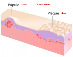 - Left: Papule (raised lesion <1 cm)
- Right: Plaque (raised lesion >1 cm)