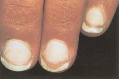 nail plate turns white with a ground-glass appearance, a distal band of reddish brown, and obliteration of the lunula. Commonly affects all fingers, although may appear in only on finger. Seen in liver disease, usually cirrhosis, heart failure, an...