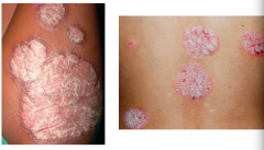 Case 4:
- 32 yo Caucasian female w/ 3-year history of scaly lesions on elbows and knees
- In past month, similar lesions on torso, lesions are mildly pruritic 
- Maternal grandmother has similar lesions

Her exam shows well-demarcated pink-re...
