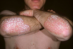 Plaque psoriasis on elbows (well-demarcated)