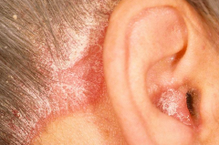 Scalp psoriasis - well demarcated plaques with silvery white scales