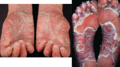 Palmoplantar Psoriasis
- Palms and soles can be involved in isolation or with other areas