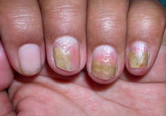 Nail Psoriasis
- Isolated finding or in association with cutaneous findings