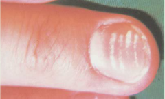 trauma to the nails is commonly followed by nonuniform white spots that grow slowly out with the nail. Spots in the pattern illustrated are typical of overly vigorous and repeated manicuring