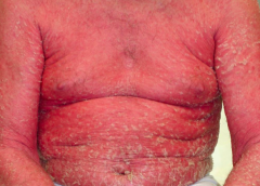 Psoriasis: Erythroderma
- Wide-spread erythema can be similar to a severe drug eruption, but it appears with history of psoriasis