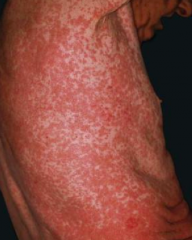 Case 5:
- 53 yo man w/ 2 day history of pruritic eruption on torso and extremities
- PMH of hypertension, treated with atenolol

Mr. Ryan’s exam shows red blanching macules and papules on the torso and extremities. How would you describe thi...