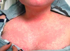 What word describes this rash?