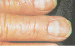 curving, transverse white bands that cross the nail parallel to the lunula. Arising from the disrupted matrix of the proximal nail, they vary in width and move distally as the nail grows out. Seen in arsenic poisoning, heart failure, Hodgkin's dis...