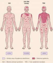 - Stevens Johnson Syndrome covers <10% of body
- Toxic Epidermal Necrolysis >30% of body

Between 10-30% of body is SJS/TEN overlap