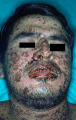 More erosions, mucus membranes involved (nose and lips)