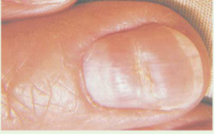 transverse depressions of the nail plates, usually bilateral, resulting from temporary disruption of proximal nail growth from systemic illness. Seen in severe illness, trauma, and cold exposure if Raynaud's disease is present
