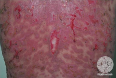 Toxic Epidermal Necrolysis (>30% of skin)
- More extensive involvement; erosions; flaccid bullae