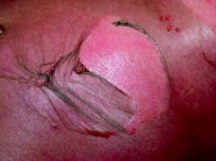 What sign is present in this patient's skin?