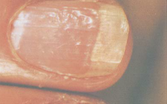 Punctate depressions of the nail plate caused by defective layering of the superficial nail plate by the proximal nail matrix. Usually associated with psoriasis but also seen in Reiter's syndrome, sarcoidosis, alopecia areata, and localized atopic...