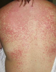 16 yo F w/ fever, pharyngitis, and LAD is started on amoxicillin for presumed Strep pharyngitis. Five days later she develops pink-red macules and papules on the trunk and extremities?

What is the underlying infection associated with this react...