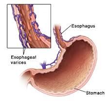 esophageal - enlarged veins in the lower part of esophgus


 


 


or gastric varices