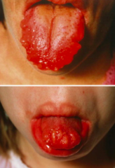 What is this tongue appearance indicative of?