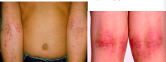 - Left: erythematous papules with secondary excoriation
- Right: erythematous plaques with lichenification