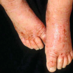 Impetiginization - yellow crusting in areas of atopic dermatitis