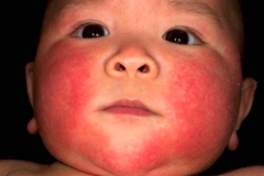 Infantile Eczema - red, acute looking, oozing, can be yellow and crusty by secondary infection
