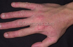 Adult Eczema - very variable, but often just hand dermatitis
