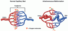 Arteriovenous malformations (AVM's)

Arteriovenous fistulas (AVF's)