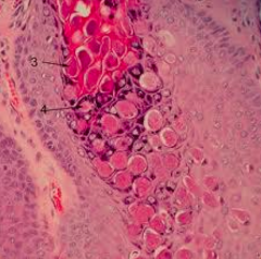 - Molluscum bodies: large eosinophilic inclusions in cytoplasm = viral factories
- Very little inflammation b/c they have immunomodulatory responses that stop all of our defenses