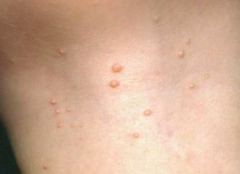 Molluscum Contagiosum
- Usually not very inflammatory, unassuming lesions
- Typically described as umbilicated (central depression)