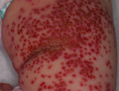 - Sudden eruption of painful, edematous, crusted vesicles, pustules and erosions
- May be associated with high temperature, malaise, LAD