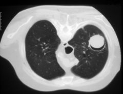 - pulmonary aspergilloma (fungus ball) is caused by inhalation of spores into the lung. Patients with a history of sarcoidosis, histoplasmosis, tuberculosis and bronchiectasis are at risk
- it presents with chronic cough, hemoptysis may be presen...