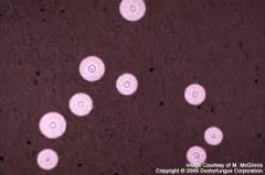 1. caused by cryptococcus neoformans, a budding, round yeast with a thick polysaccharide capsule
2. associated with pigeon droppings
3. most commonly seen in patients with advanced AIDS
4. infection is due to inhalation of fungus into lungs. He...