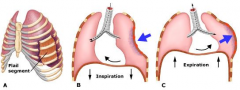When multiple rib fractures allow a segment of the chest wall to cave in during inspiration and bulge out during expiration (paradoxic breathing)