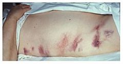 Equimosis masiva típicamente localizada en los flancos abdominales, la región lumbar y periumbilicales.
Pancreatitis hemorrágica o estrangulación intestinal, ruptura ahorita.  