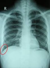 Space between costal and diaphragmatic portions that is MOST COMMON for pleural fluid accumulation