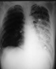 Lung filled with fluid
- wedge-shaped, echo-poor lung
