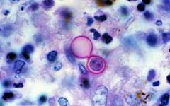 - caused by blastomyces dermatitidis- dimorphic fungus
- transmission is via inhalation of spores from the environment
- clinical features- disseminated infection-- chronic, indolent disease, constitutional symptoms, lymphadenopathy, pneumonia
...