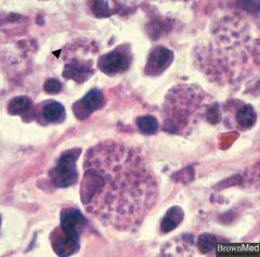 - caused by histoplasma capsulatum (dimorphic fungue with septate hyphae)
- transmitted via exposure to bird/bat droppings (endemic in Ohio and Mississippi river valleys)
- clinical features: flu-like symptoms, erythema nodosum, hepatosplenomega...
